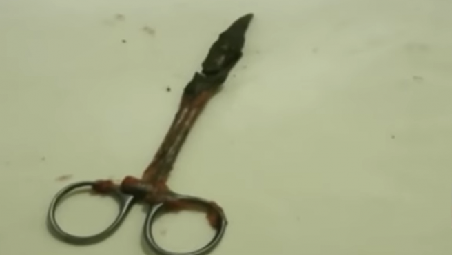 BANGLADESH. Extraen una tijera del abdomen de una mujer tras pasar 20 años con ella dentro por una negligencia médica